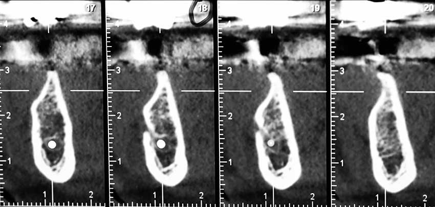 Risoluzione di una grave atrofia ossea con la tecnica della lamina